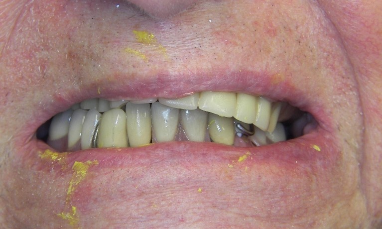 Flexible Partial Dentures Hamlin TX 79520